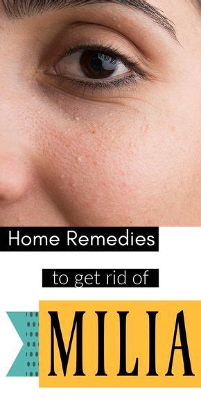 How To Get Rid Of Milia 5 Amazing Home Remedies Milia Homeremedies