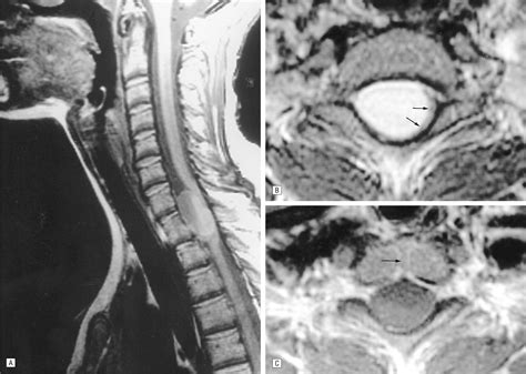 Spinal Neurenteric Cyst Congenital Defects Jama Neurology Jama