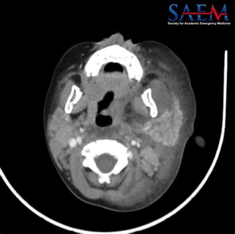 Saem Clinical Image Series Facial Swelling In A 2 Year Old Med Tac