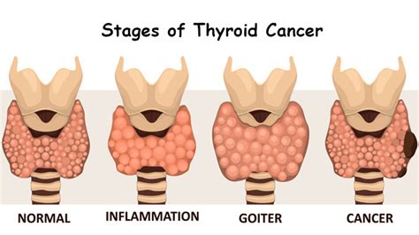Thyroid Cancer Surgery Specialist In Thane Thyroid Cancer Hopsital In