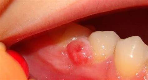On The Gums There Was A Bump With Pus What To Do