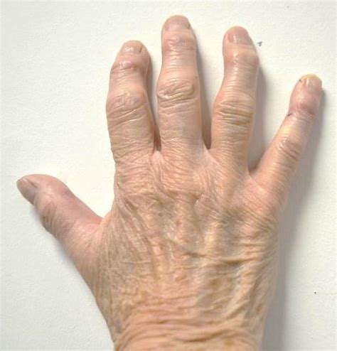 List 104 Images Photos Of Osteoarthritis In Hands Sharp