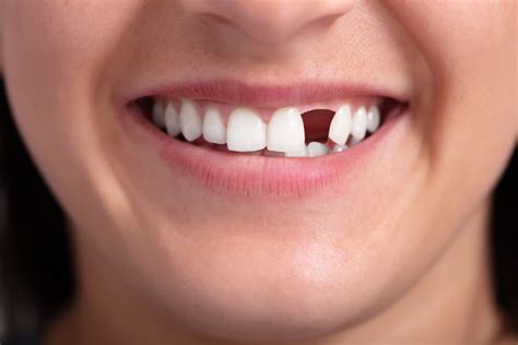 Apakah Gigi Bisa Maju? Jawaban atas Pertanyaan yang Sering Ditanyakan