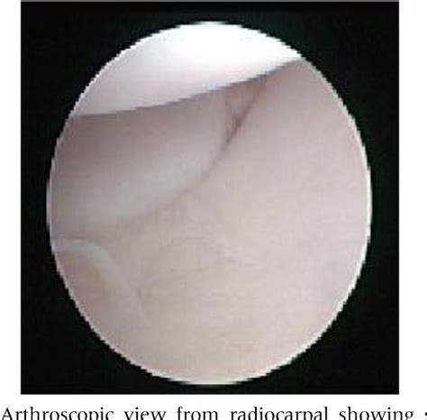 Figure From Arthroscopic Treatment Of Intraosseous Ganglion Cyst Of The Lunate Bone