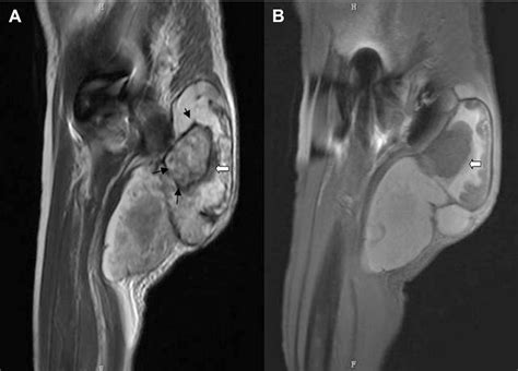 Figure 1 From Massive Gluteal Mass Mimicking Sarcoma Chronic Expanding