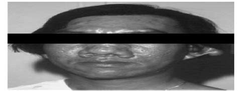 Calcospherules Associated With Juvenile Hyaline Fibromatosis The