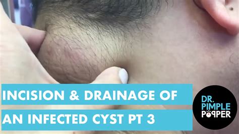 Incision And Drainage Of An Infected Cyst Part 3 Of 3 Dr Pimple Popper