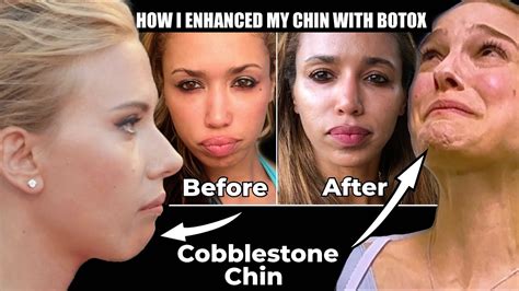 Botox To The Chin Before And Afters What Is Cobblestone Chin Youtube