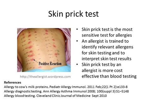 Skin Prick Test The Allergist