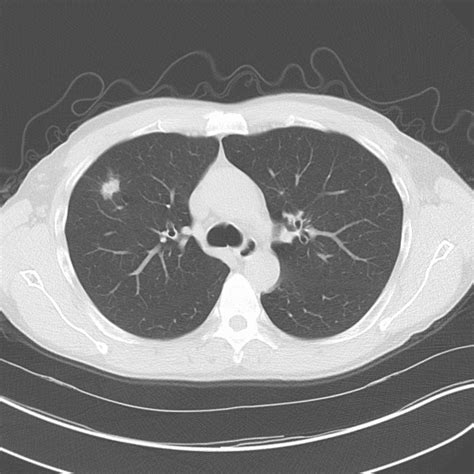 Pulmonary Insights Tackling Lung Cancer A Multidisciplinary Approach