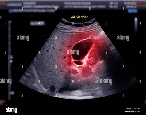 Ultrasound Upper Abdomen Showing Gallbladder For Diagnosis Gallbladder