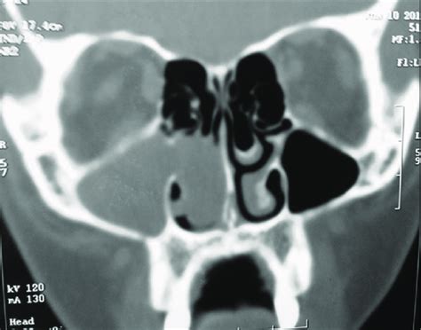 Ct Scan Of The Paranasal Sinus Showing Opacification Of The Right