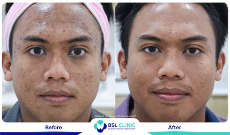 Skin Brightening And Whitening Treatment Bangkok Aesthetic Clinic