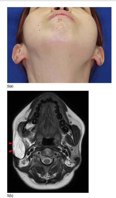 Figure 5 From Surgical Treatment For A Giant Venous Malformation Of The
