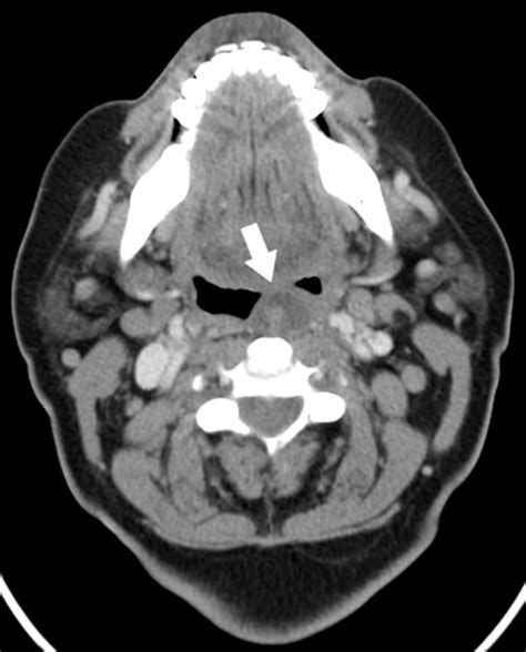 Contrast Enhanced Ct Scan Axial View White Arrow Showing The