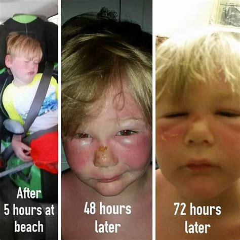 2nd Degree Burns On Face Before And After