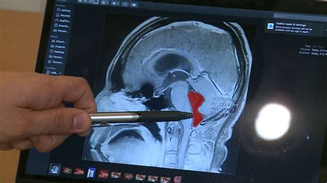 Tapeworms Infected A Mans Brain Causing Years Of Headaches His