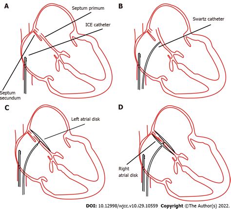 Novel Way Of Patent Foramen Ovale Detection And Percutaneous Closure By