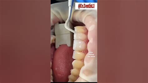 Whitening Pigmented Teeth By Using Composite Restoration On Bacall