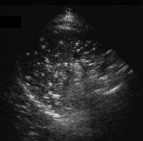 Ultrasound Of The Spleen On The Same Patient As In Figure 41 Showing