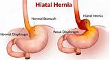 Pictures of Hiatal Hernia Diagnosis And Treatment