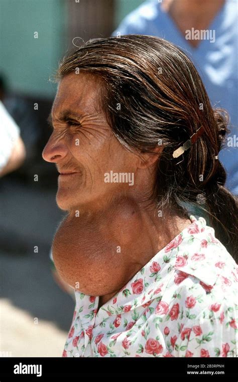 Goiter Enlargement Of Thyroid Hi Res Stock Photography And Images Alamy