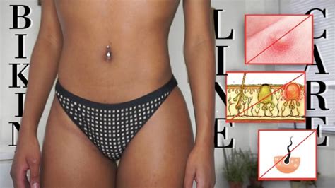 Learn more about ingrown hairs, causes and how they become cysts, how to treat with medications or removal methods. Pin on Beauty