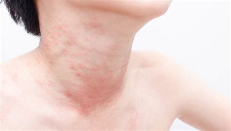 Hives Can Be Caused By Stress Thomson Specialist Skin