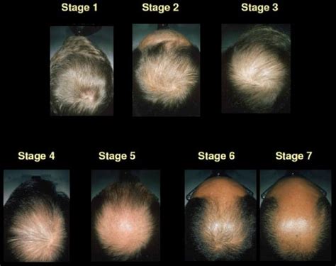 Heres How And Why Men Go Bald Oasdom