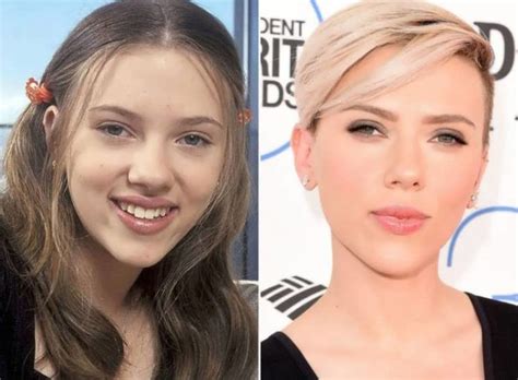 Has Scarlett Johansson Had Plastic Procedures Before And After