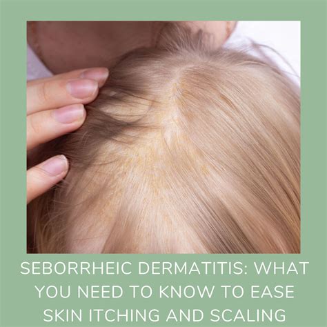 Seborrheic Dermatitis What You Need To Know To Ease Skin Itching And Scaling Odylique