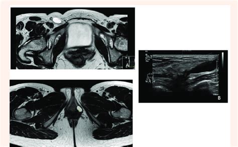 A. example of an MRI image of a cyst of Nuck. B. example ...