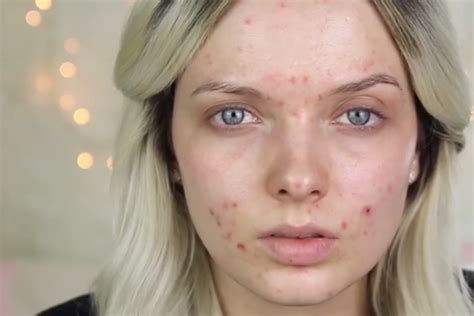Women Are Posting Makeup Free Selfies To Spread Acne Positivity The