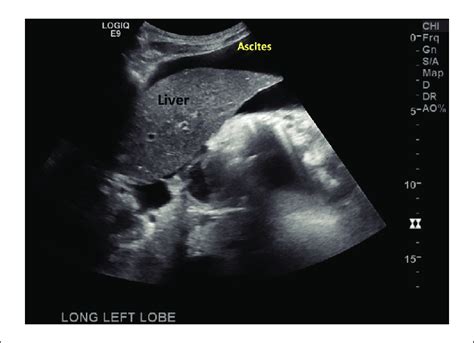 Abdominal Sonography Demonstrating A Large Amount Of Ascites Around The