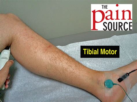 Setup Tibial Motor Ncs The Pain Source Makes Learning About Pain