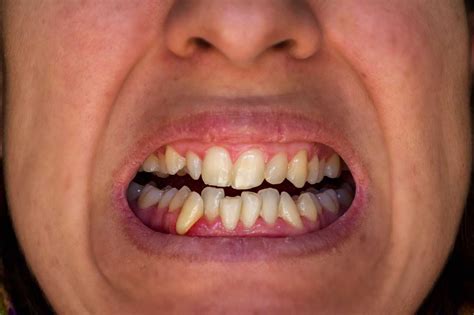 Signs Of Teeth Grinding At Night Springvale Dental Smiles