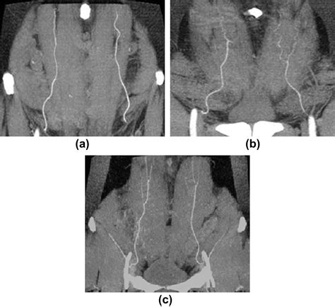 Ct Guided Deep Inferior Epigastric Perforator Diep Flap Localization