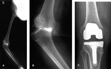 The Correction Of Severe Varus Deformity In Total Knee Arthroplasty By