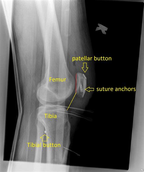 Patella Tendon Rupture And Repair With Augmentation And Suspensory