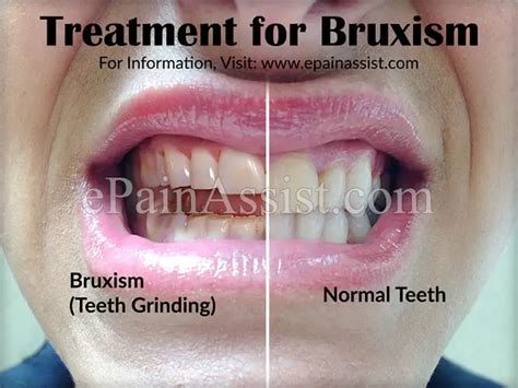 Bruxism Teeth Grinding Causes Risk Factors Symptoms Treatment