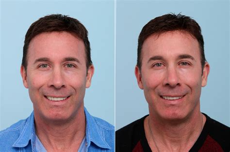 Botox Cosmetic And Xeomin Photos Houston Tx Patient 7757
