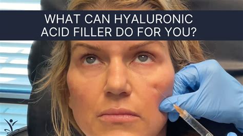 Hyaluronic Acid Filler For Tear Troughs Juvederm Ultra Youtube