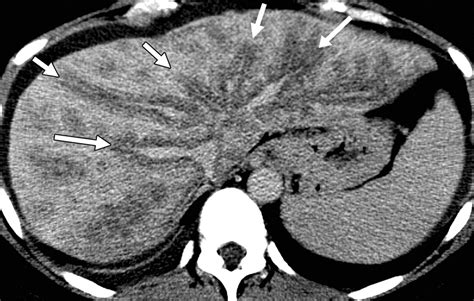Fatty Liver Imaging Patterns And Pitfalls Radiographics