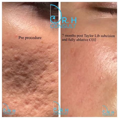 Acne Scar Laser Treatment And Removal London Dr H Consult