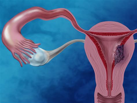 Endometrial Cancer Histology