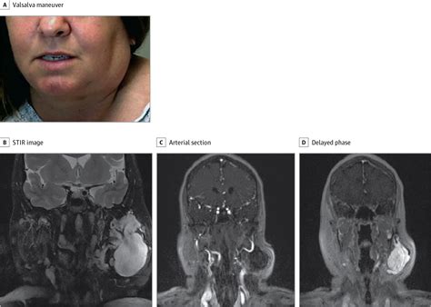 Recurrent Unilateral Swelling Of The Parotid Gland Otolaryngology