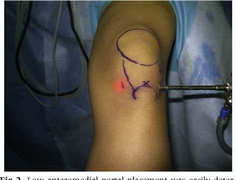 Pdf Direct Bursoscopic Ossicle Resection In Young And Active Patients