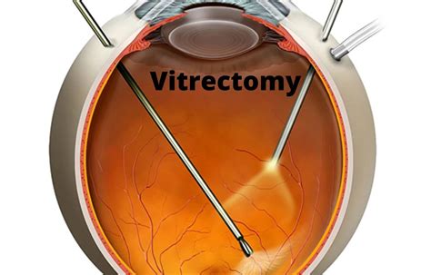Vitreous Opacity Vitrectomy Safe And Effective For Removal Of Floaters