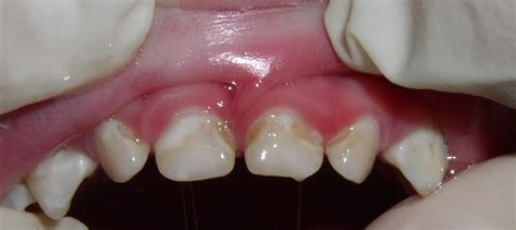 What Are These White Spots On My Childs Teeth Teeth And Chiefs Images