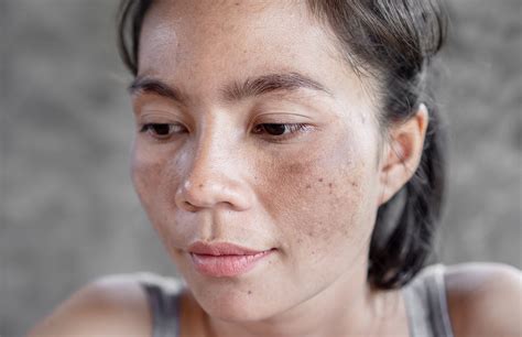 How To Remove Dark Spots On Face